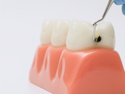 Cómo prevenir las caries en los niños de forma natural